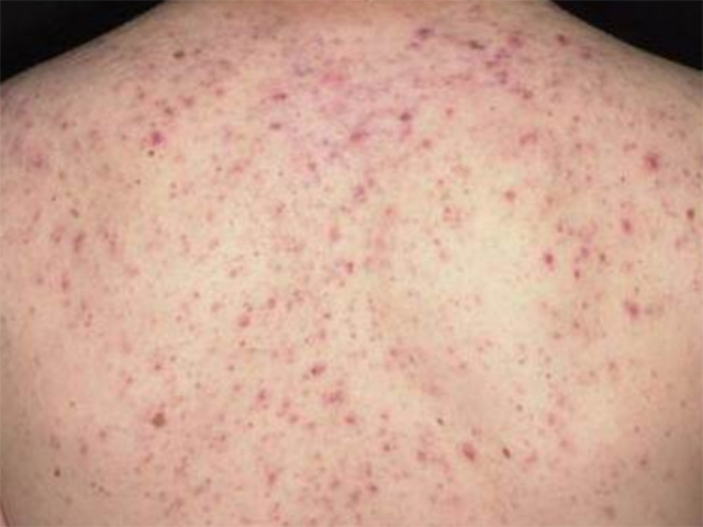 Sức đề kháng kém làm vi khuẩn tấn công vào vùng da lưng gây viêm nang lông và hình thành mụn lưng